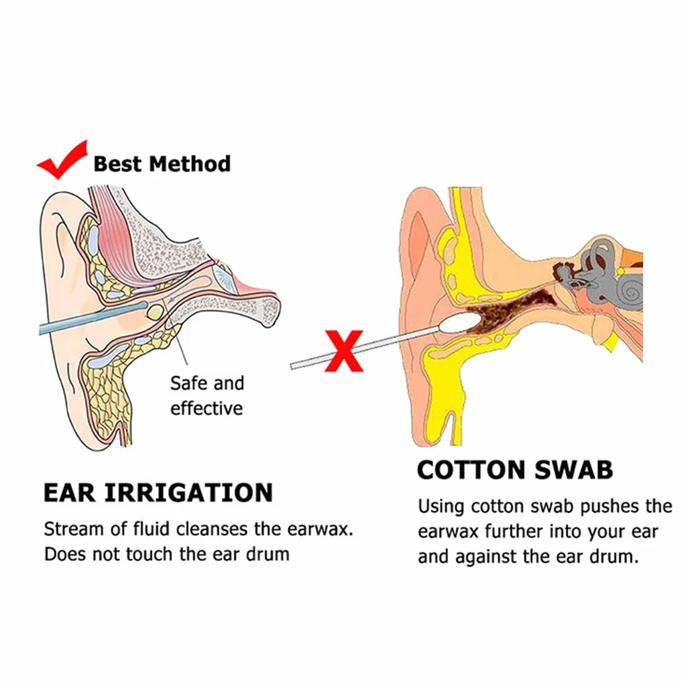 Kit de Nettoyage de Cire à Oreille avec Laveuse, Flacon en Caoutchouc et Seringue